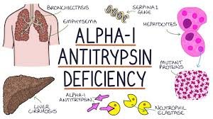 what is alpha 1 antitrypsin (a1at) deficiency